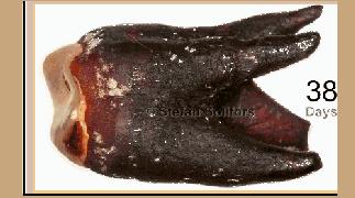 不健康牙齿,不健康牙齿颜色对照图