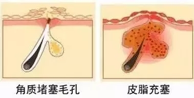 长闭口粉刺可以用卸妆水去闭口吗,什么是闭口粉刺用什么药膏
