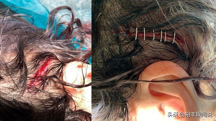 萧亚轩带病直播,萧亚轩摔倒视频