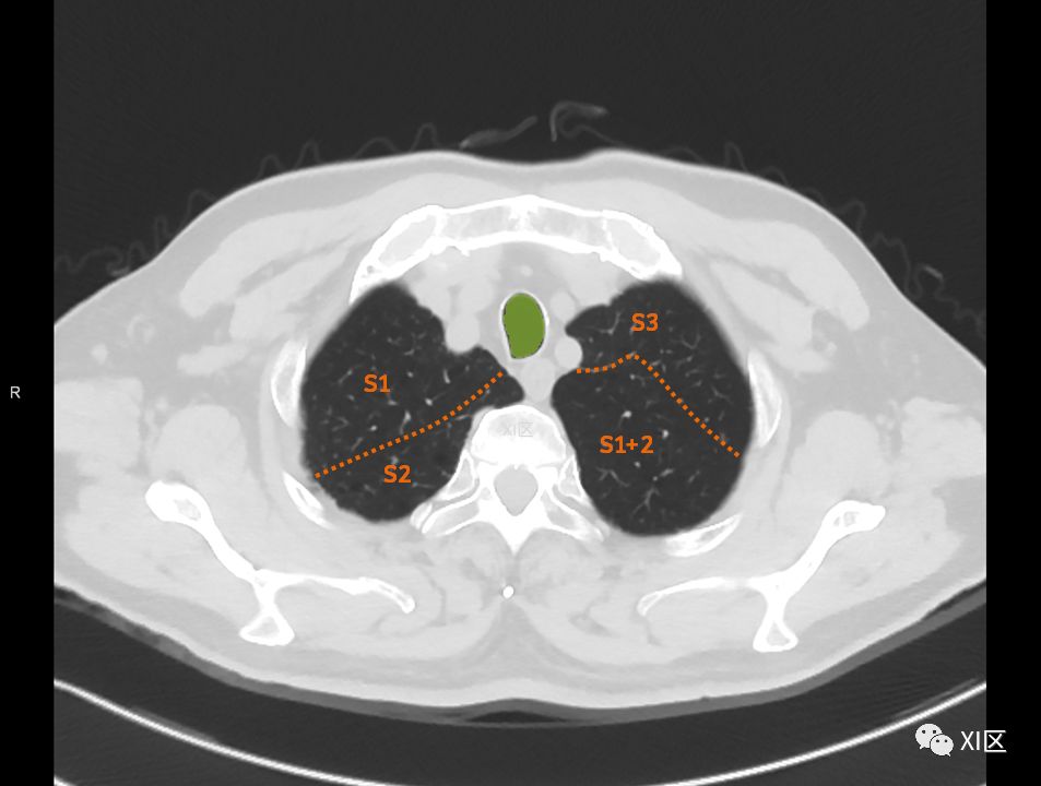 如此详细的肺部影像解剖，有点儿酷
