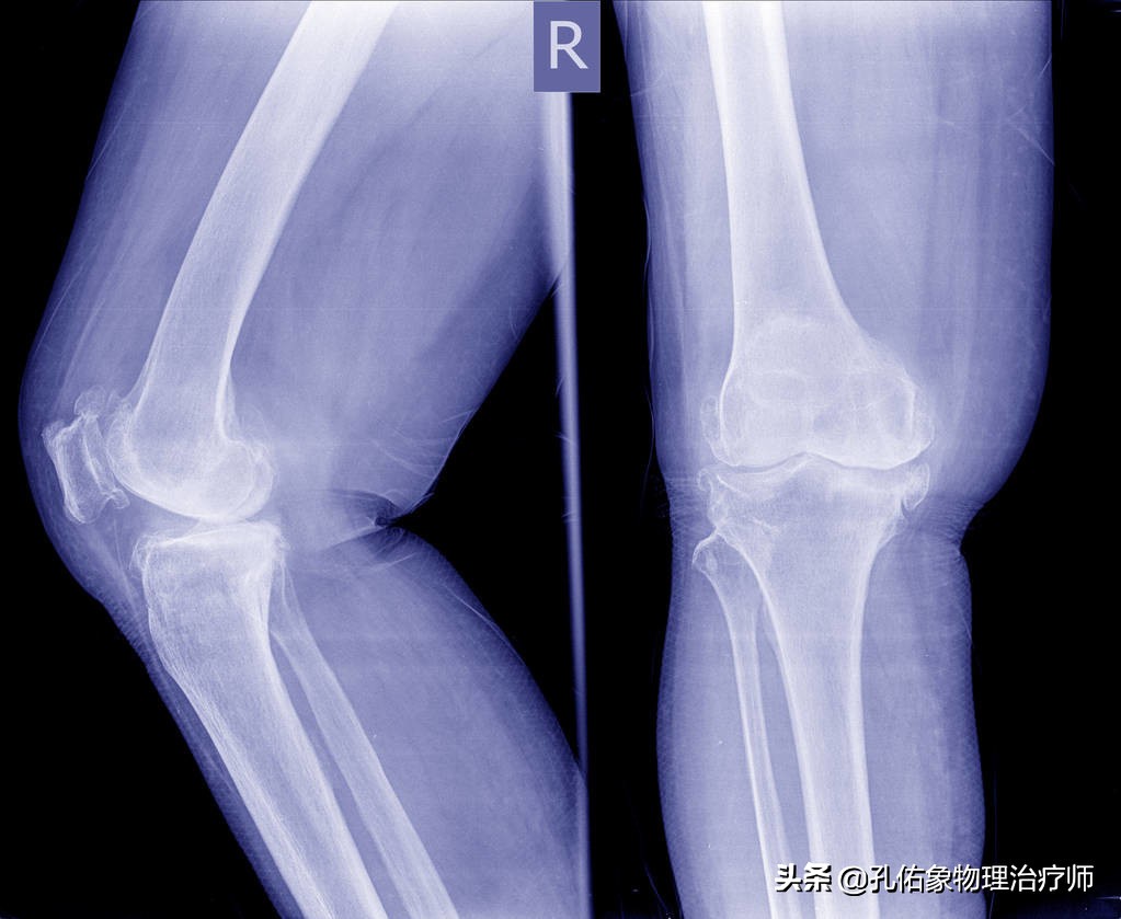 膝疼的最佳治疗方法,如何克服膝痛