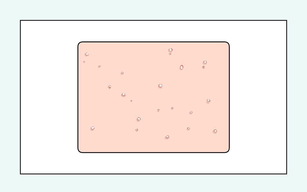 脸上的红疙瘩疼是什么原因,脸上的各种疙瘩