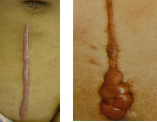 关于疤痕疙瘩，你知道多少？