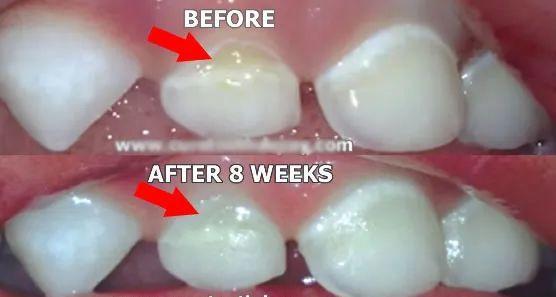 伤害牙齿的食物图片,伤害健康的食物