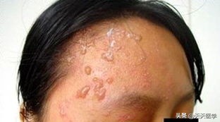 带状疱疹治愈后两年还有神经痛吗,带状疱疹后遗神经痛最新疗法