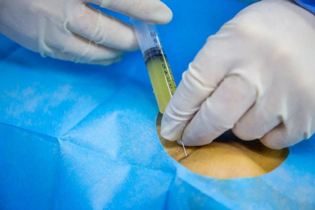 prp自体治疗,自体prp注射