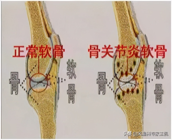 类风湿关节炎的先兆,类风湿关节炎能治愈吗