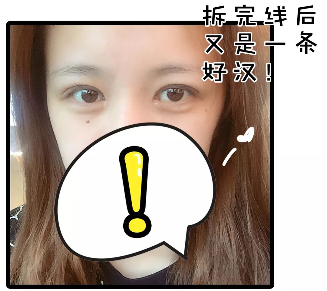 割双眼皮术前术后对比图,割双眼皮术前需要注意事项