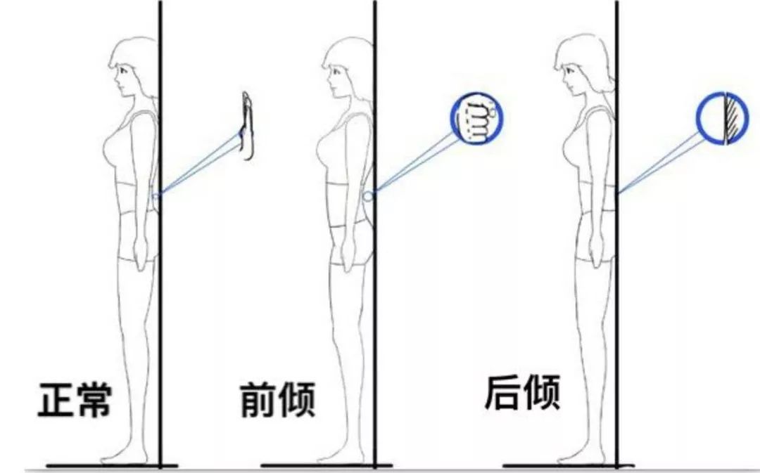 体态不好说明脊柱侧弯吗,骨盆倾斜造成哪些体态问题