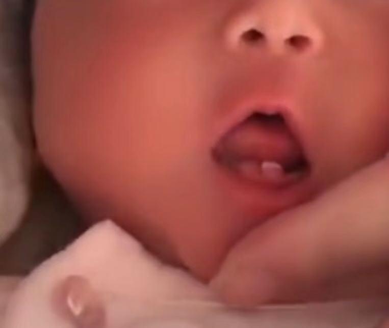 新生儿诞生牙案例,婴儿出生时已萌出的牙齿