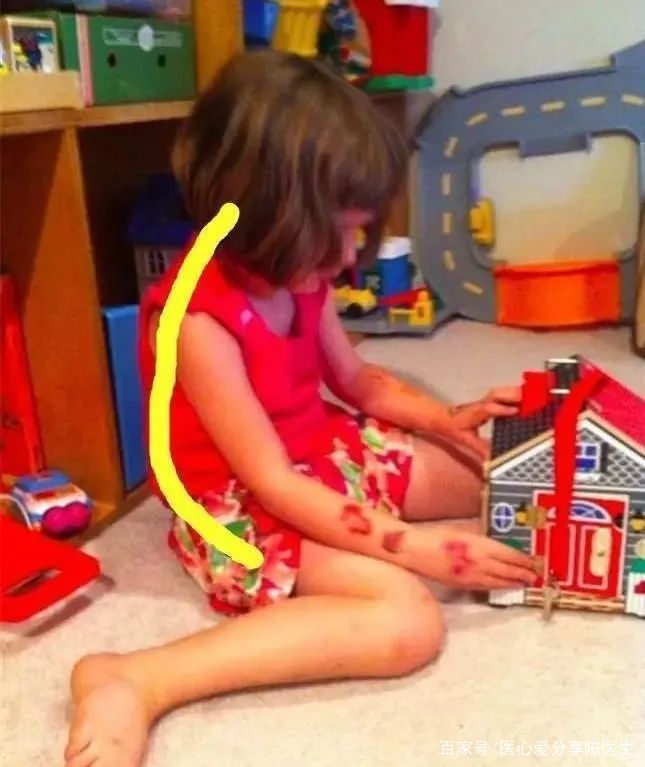 小儿歪头怎么治疗,小孩子面部倾斜怎么改正