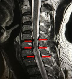 一例颈椎病患者的护理案例,医生一个动作治疗颈椎病
