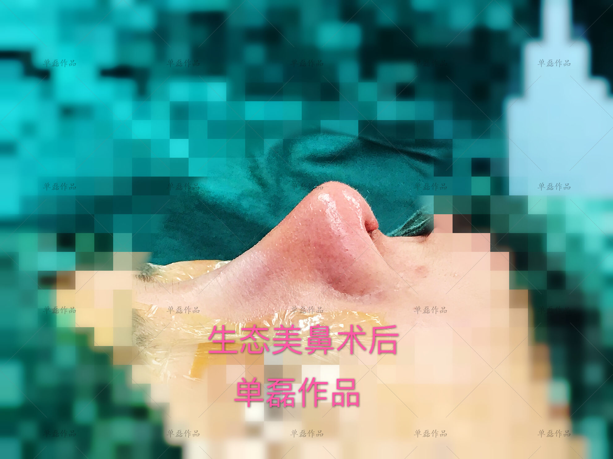 驼峰鼻怎么打鼻影,驼峰鼻用什么材料隆鼻