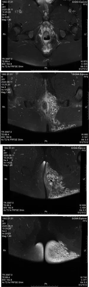 外阴坏死性筋膜炎,坏死性筋膜炎基础研究