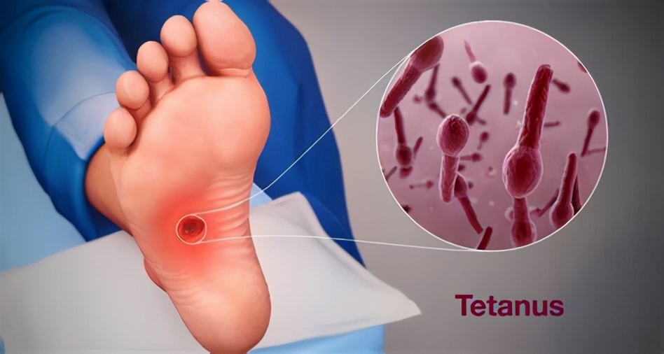 外伤处理后必须要打破伤风吗,受伤后为什么要打破伤风针