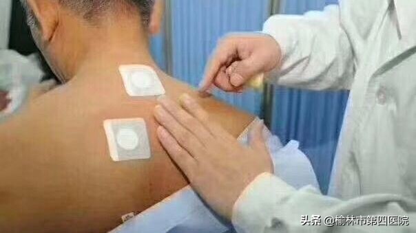 榆林市星元医院“冬病夏治”贴敷治疗项目正式启动