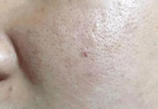 皮肤粗糙毛孔粗大最快的解决办法,皮肤松弛毛孔粗大黑头多怎么解决