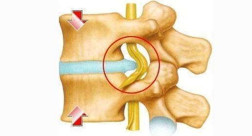阶梯治疗!腰间盘突出你需要了解的真相