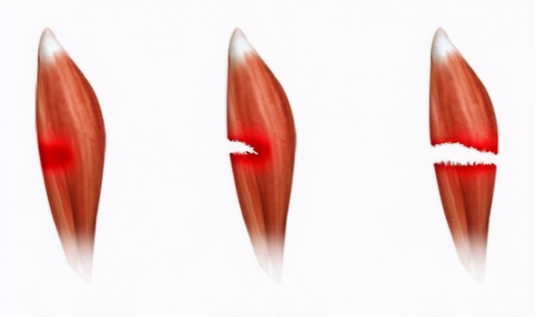 运动小腿拉伤怎么处理,运动不当拉伤什么时候可以缓解