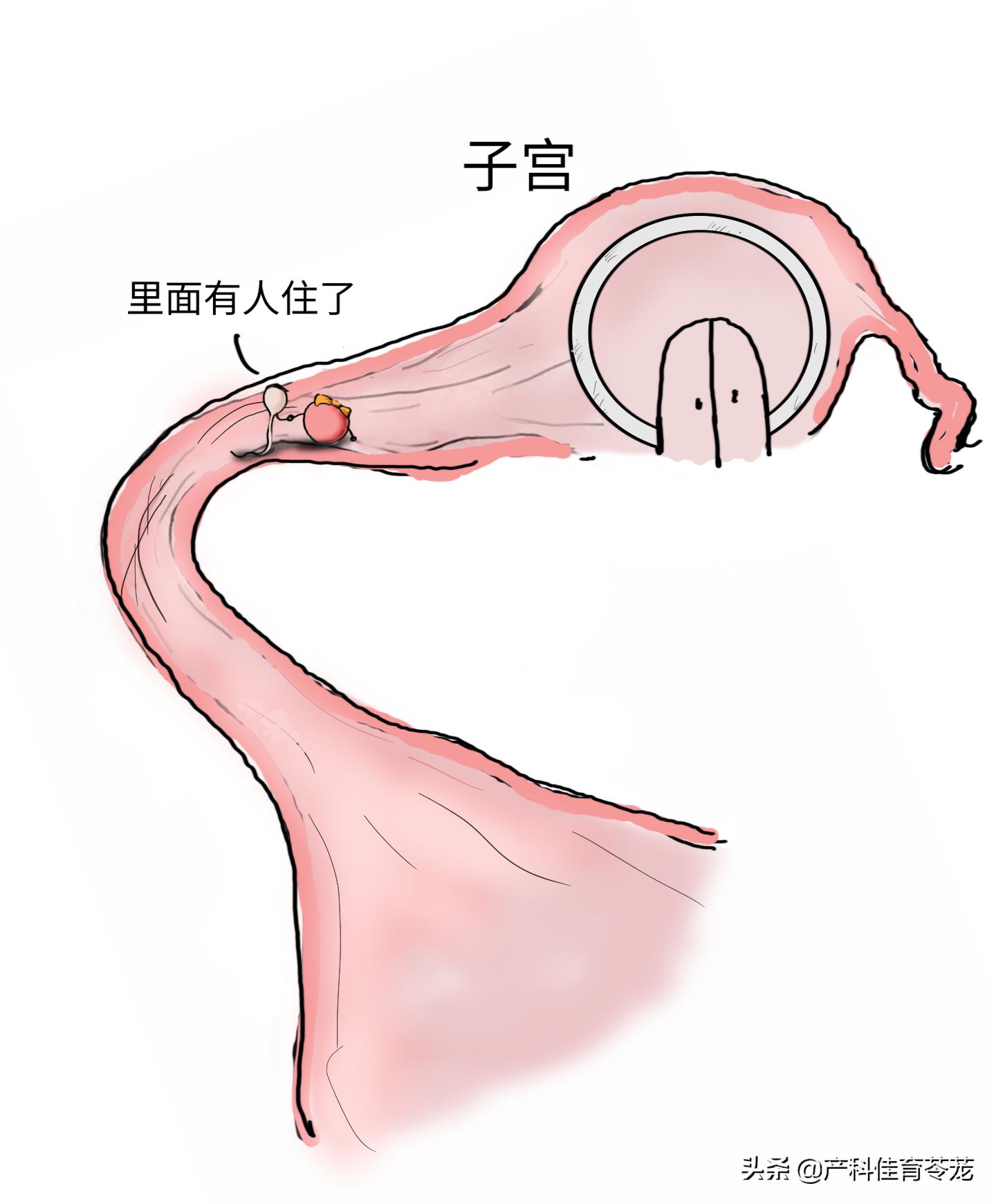 跑步能预防宫外孕吗,试管怎么预防宫外孕