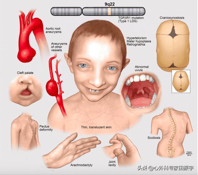 胸主动脉瘤最常见的护理措施,胸主动脉疾病