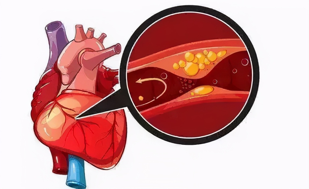 心肌梗塞多可怕,心肌梗死危险性