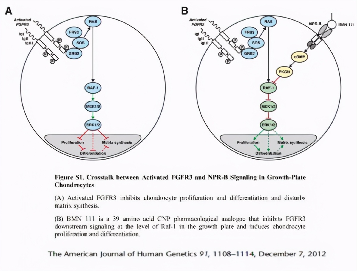 软骨发育不全综合征手术,先天性软骨发育不全矫正