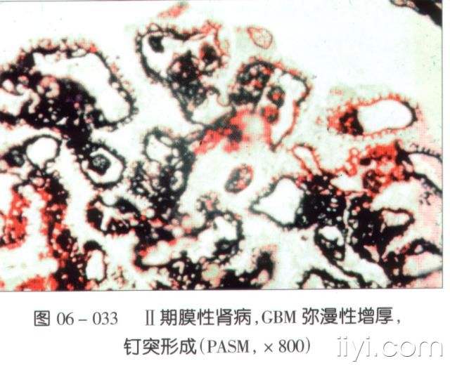 膜性肾病的尿蛋白，为何这么难消除？