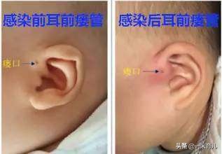 小孩的耳朵怎么护理,宝宝耳朵有异物医生怎么洗