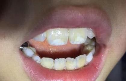 你的牙齿变黄了怎么办,你的牙齿为什么会那么白