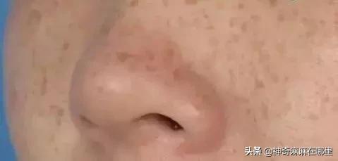 为什么用美白精华皮肤变白,为什么用了美白护肤品反而变黑了