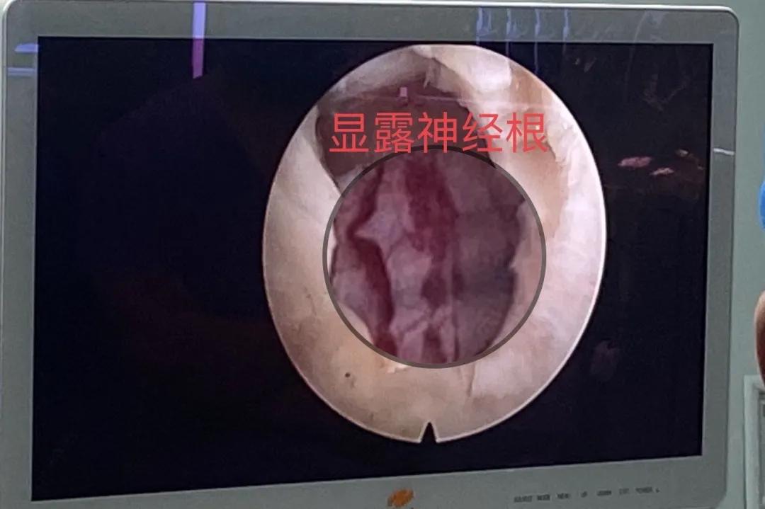 渭南治腰间盘突出哪家最好,脊柱神经外科手术
