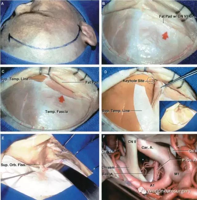 翼点入路技巧图解,翼点入路的开颅要点