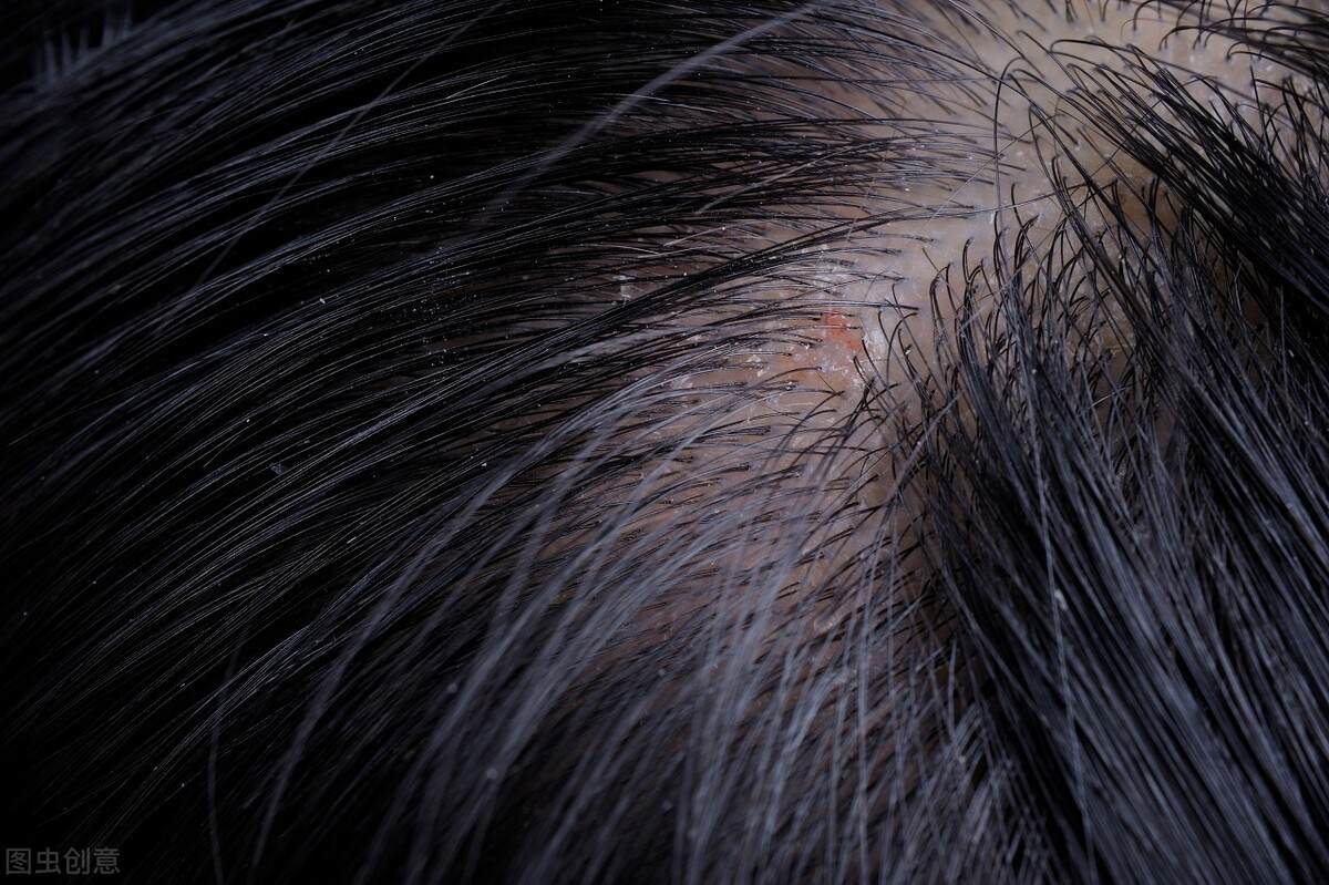 头屑多脂溢性皮炎用什么可以洗掉,头屑多了如何处理