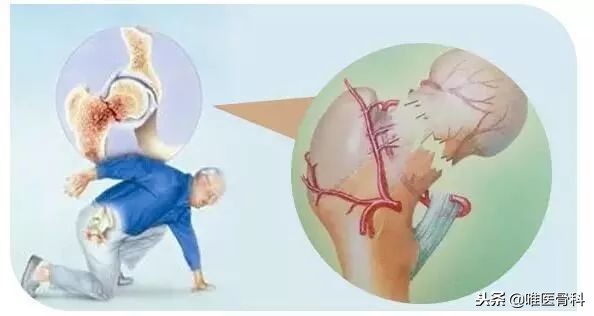 老年人骨折最怕什么病,老年人最常见的骨折有哪些