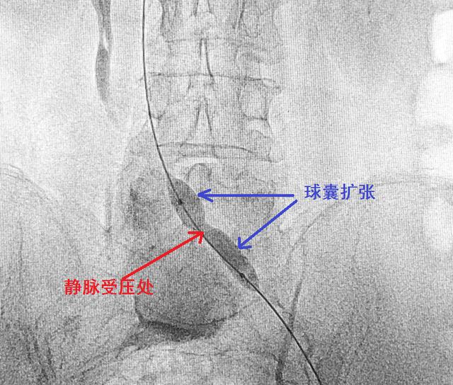 血管被堵怎么办？别怕！微创介入诊疗已有多种腔内开通手段！