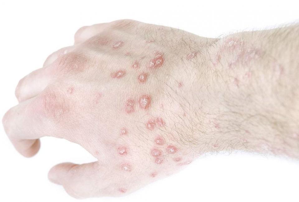 儿童牛皮癣怎么治疗才能彻底根除,目前全国治疗牛皮癣用的生物制剂