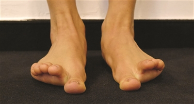 脚趾为什么那么不灵活,脚踝扭伤后恢复后脚趾头不灵活