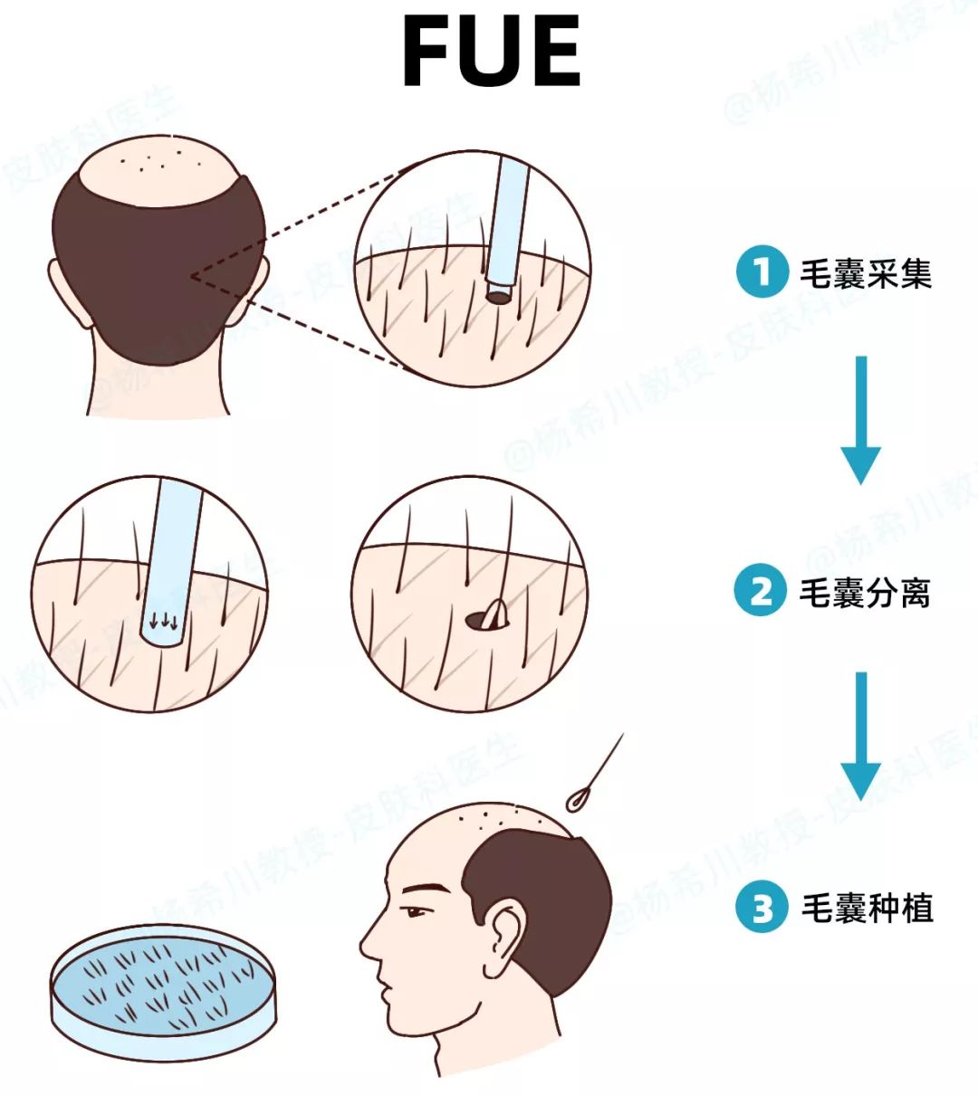 植发的来源从何而来,植发的发从哪里来的