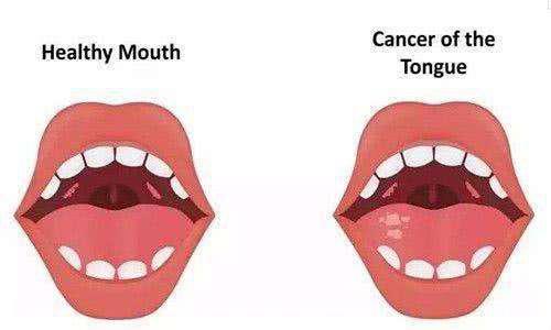 舌癌术后康复功能训练(上)——舌癌术后康复之言语篇