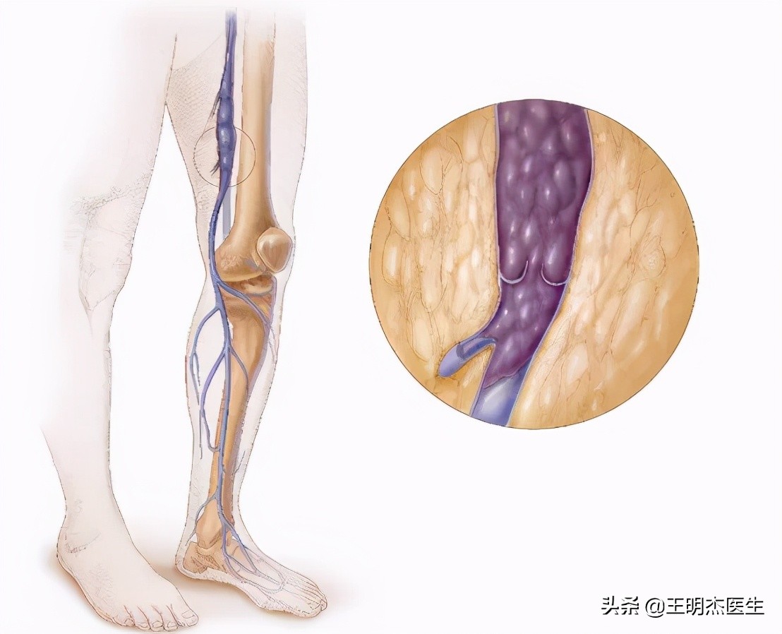 防止下肢静脉血栓形成的药物,抗凝药能使下肢深静脉血栓溶掉吗