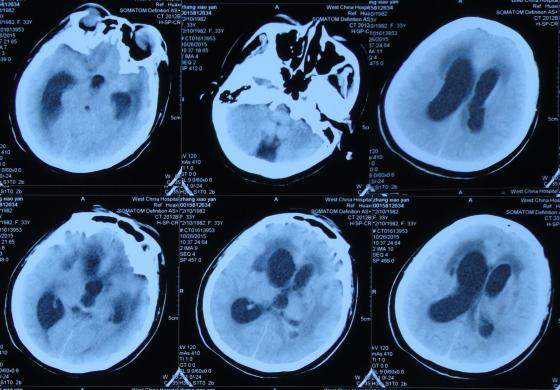 结核性脑积水,脑膜炎脑积水要治疗多久