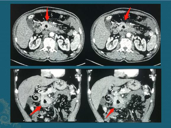29岁肠癌晚期生命仅剩半年,29岁得了肠癌怎么办