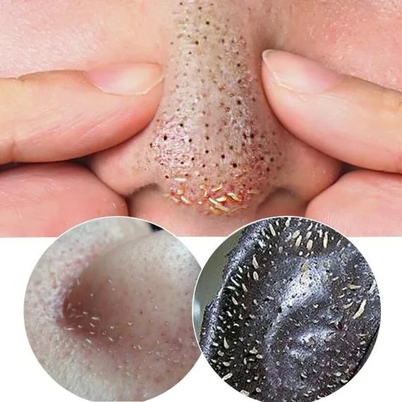 黑头镊子清理过程,专业黑头清理过程