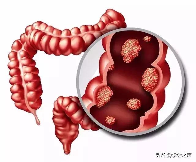 肉肿瘤最简单的去除方法,肉里长瘤子会癌变吗