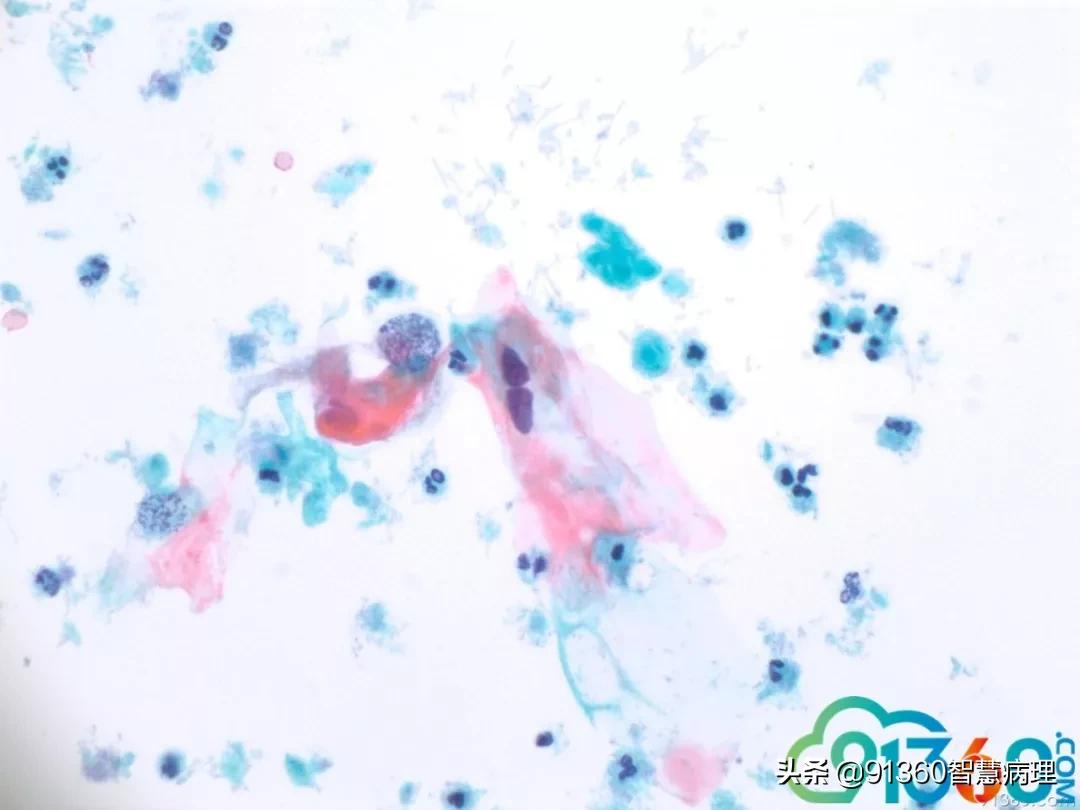 宫颈病理检查与tct检查的区别,病理诊断宫颈活检鳞癌