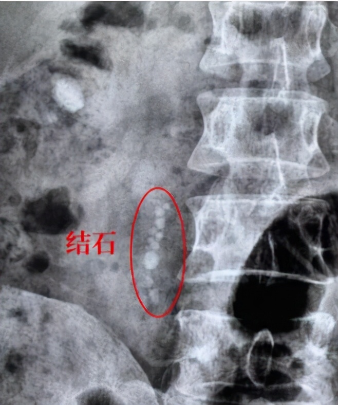 体外冲击波碎石取石术,体外冲击波碎石多少钱一次