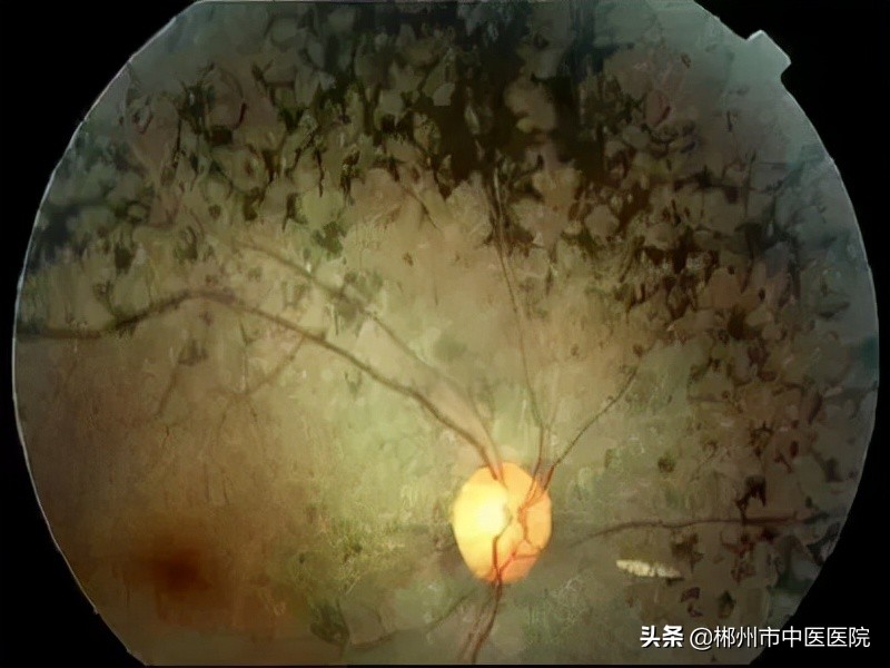 视网膜不健康的前兆有哪些,缺乏什么营养会引起视网膜的损害