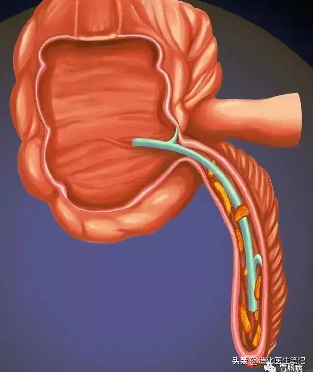 阑尾炎不开刀还有其他办法,治疗阑尾炎的最好的治愈方法