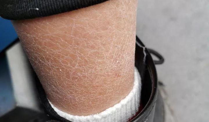 鸡皮肤严重的人图片,很严重的鸡皮肤能治好吗